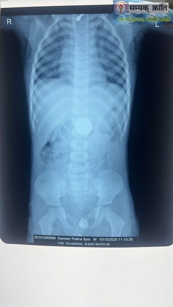 IMG-20251010-WA0035-576x1024 तीन वर्षीय बालक ने निगला ₹10 का सिक्का